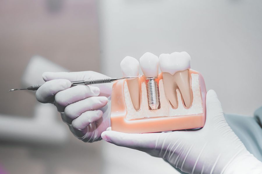 oreka-dental-implantes-dentales-implantologia